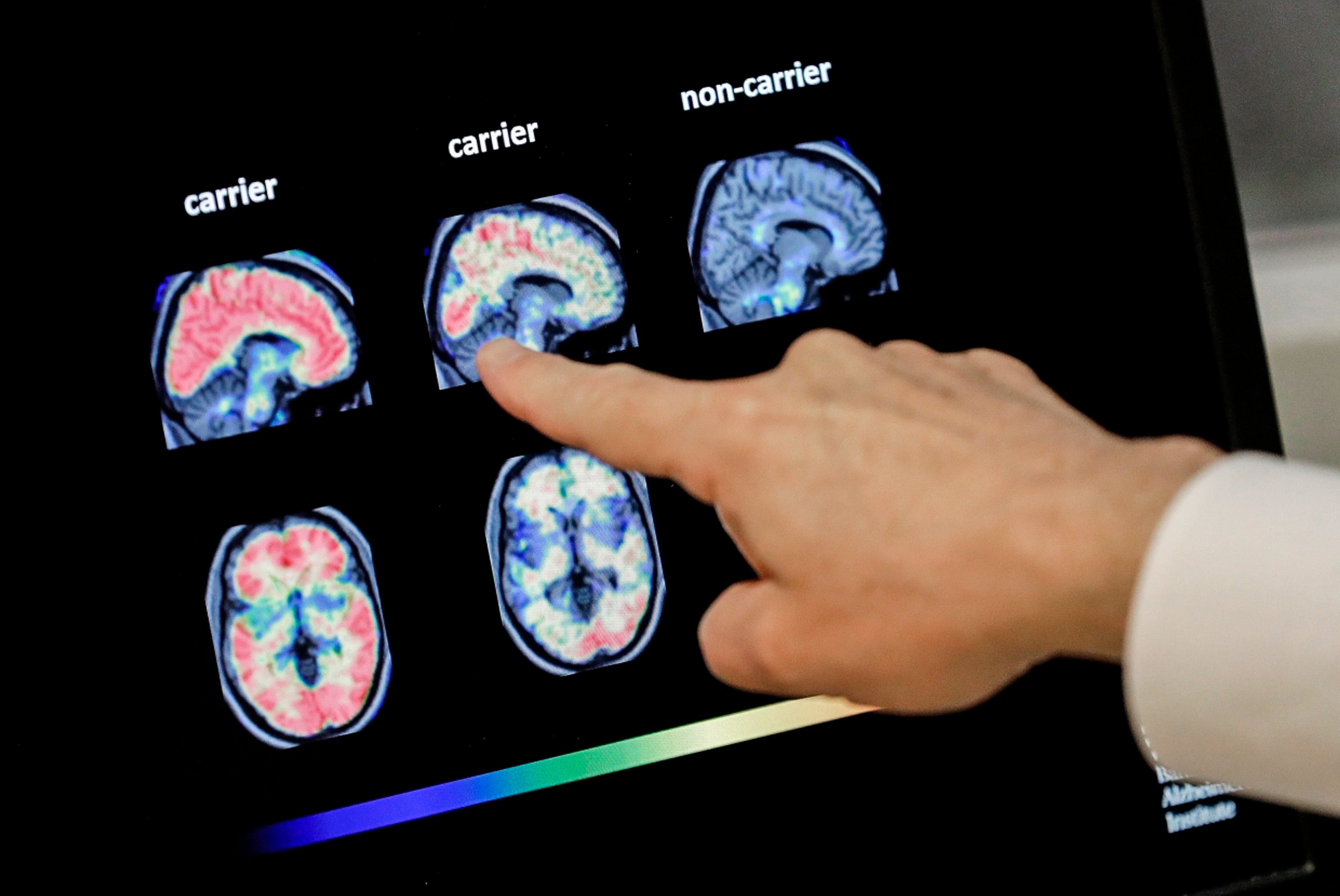 LEQEMBI — a breakthrough in treatment of Alzheimer’s disease