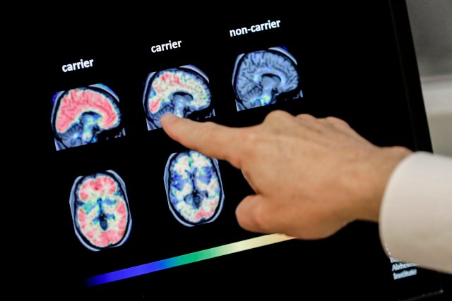 LEQEMBI — a breakthrough in treatment of Alzheimer’s disease