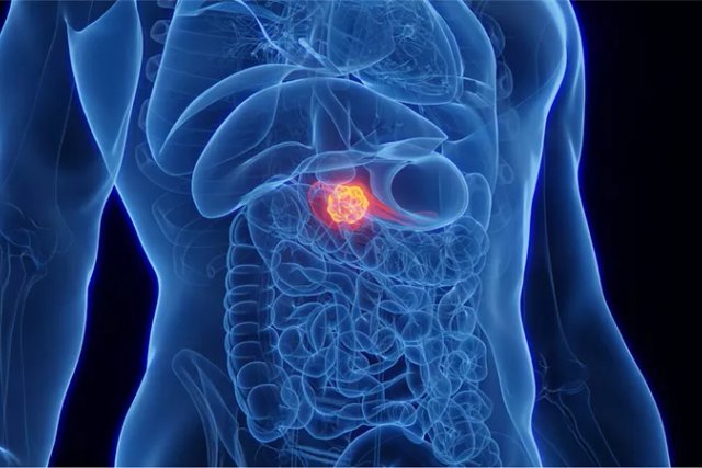 MIT researchers develop AI models enhancing early detection of pancreatic cancer